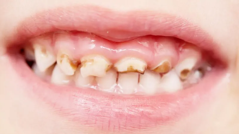 Tooth Decay Epidemic Linked To Fizzy Drinks