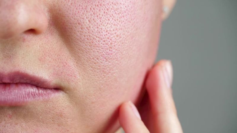 Your Skin Could Start To Clear Up