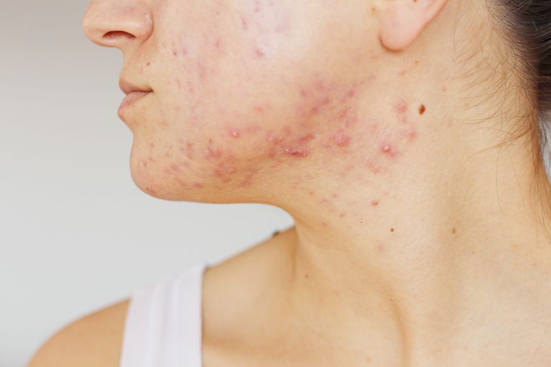 Skin Breakouts Or Acne