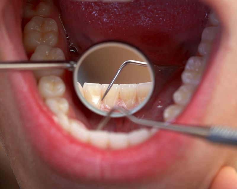 Tooth Enamel Erosion Due To Acidity