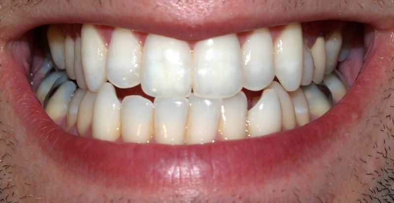 Effect On Teeth And Enamel