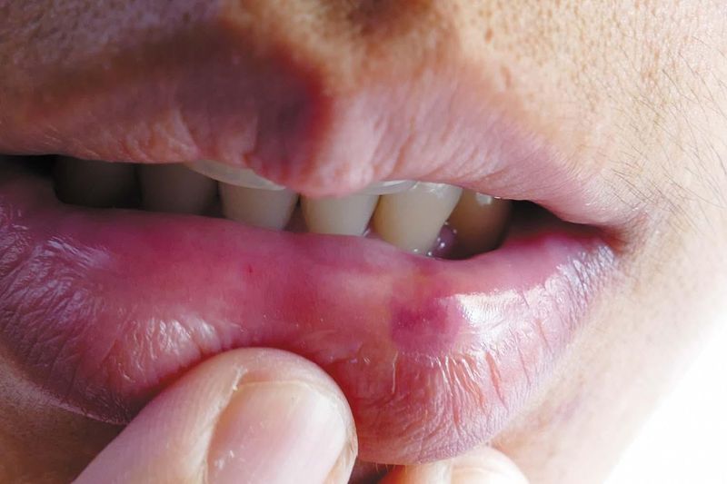 Temporary Sensitivity Or Burning Sensation On Lips