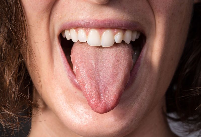 Mouth And Tongue Irritation